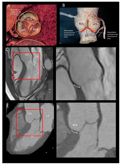 Multimodality Imaging of the Anatomy of the Aortic Root