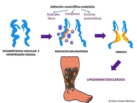 La insuficiencia venosa crónica desde una perspectiva dermatológica ...
