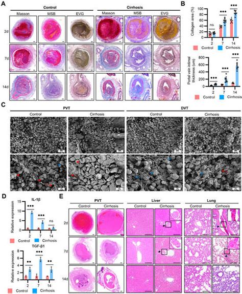 GSDMD-Dependent Neutrophil Extracellular Traps Mediate Portal Vein ...