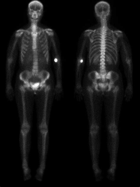 Image result for Normal Bone Scan