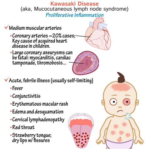 Kawasaki Disease In Adults