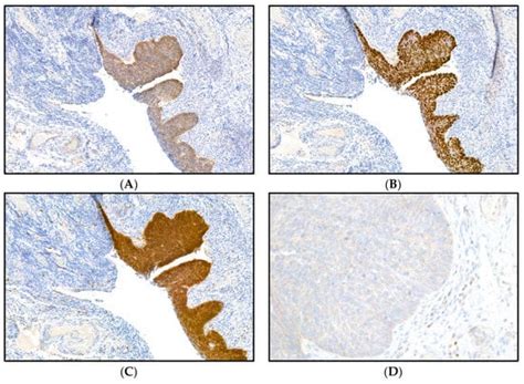 Synchronous High-Grade Squamous Intraepithelial Lesion of the Fimbria ...