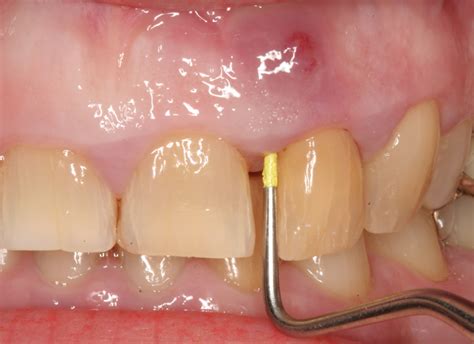 Abscessed Teeth – Perio Peak