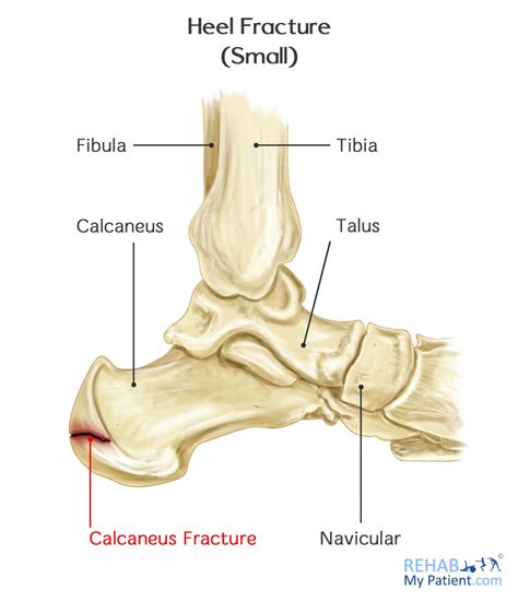 Heel Fracture | Rehab My Patient