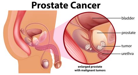 How Common Is Prostate Cancer