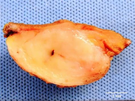 Image result for Dermatofibrosarcoma Protuberans