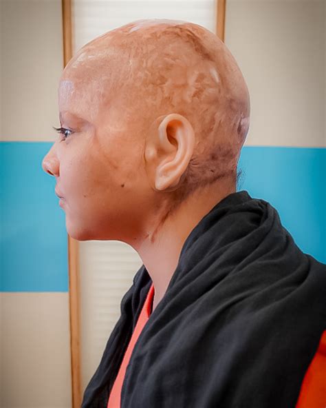 Prosthetic and Orthotic Clinic Centre | P&O International