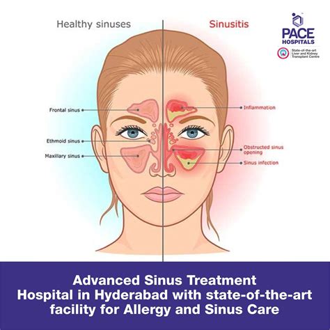 Best Hospital for Sinus Treatment in Hyderabad | Surgery and Cost