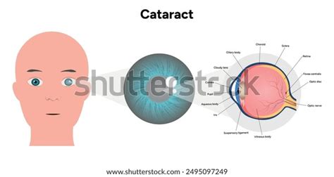 Vision Disorder 的图像结果