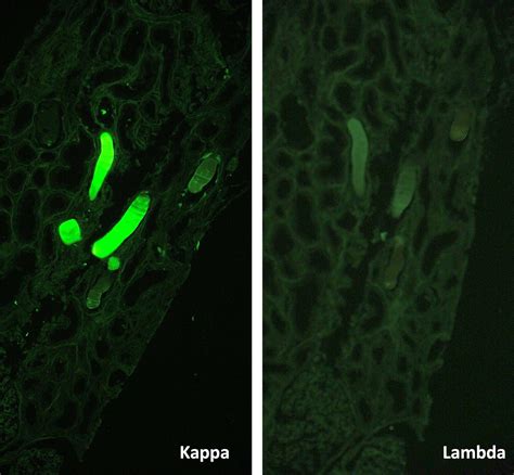 Icd 10 Code For Elevated Kappa Free Light Chain | Shelly Lighting