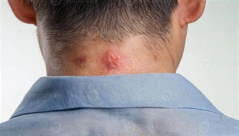 Fungal Rash On Neck 22 Different Causes Of Rashes In Babies And Their