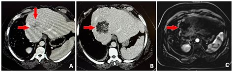 Surgery Without Scalpel: Histotripsy as a Non-Invasive and Non-Thermal ...