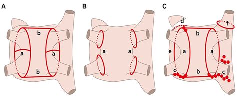 Radiofrequency vs. Cryoballoon vs. Thoracoscopic Surgical Ablation for ...