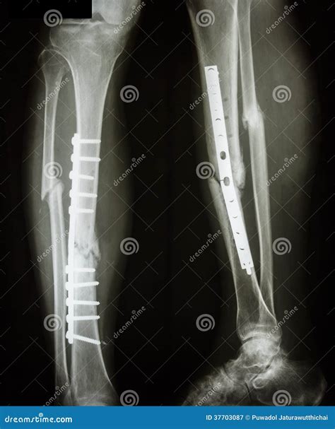 Fracture Shaft of Tibia and Fibular (leg S Bone) Stock Image - Image of ...