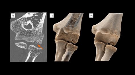 Osteochondritis dissecans of the capitellum - Siemens Healthineers