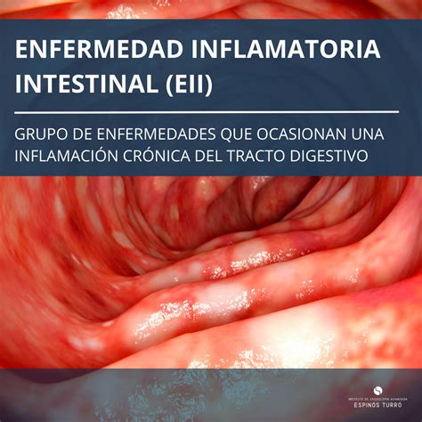 Enfermedad De Crohn Del íleon Terminal
