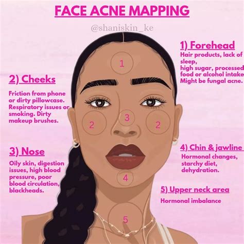 Acne mapping in 2024 | Acne mapping, Face acne, Forehead acne