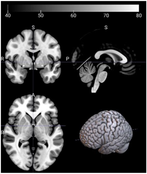 Parkinson’s Disease Classification Using Gray Matter MRI and Deep ...