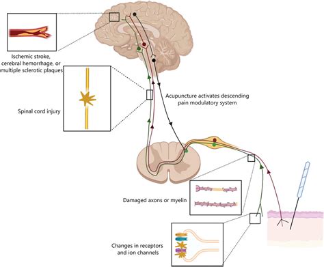 Frontiers | Potential mechanisms of acupuncture for neuropathic pain based on somatosensory system