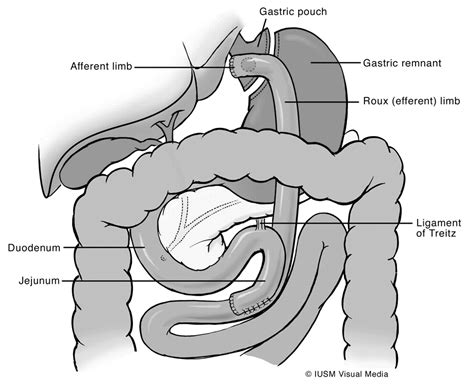 Roux En Y Afferent Limb