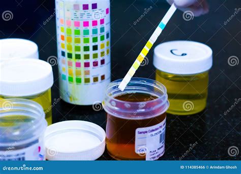 What Is Glucose In Urine Test at Ruth Schreiner blog