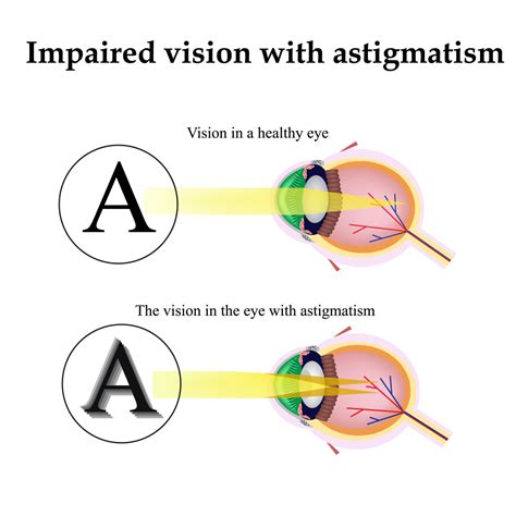 LASIK for Astigmatism: Procedure, Benefits, & Costs