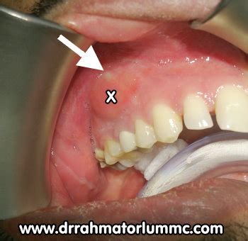 Bildergebnis für ruptured abscess in mouth