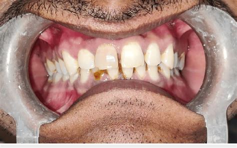 Image result for Discolored Tooth
