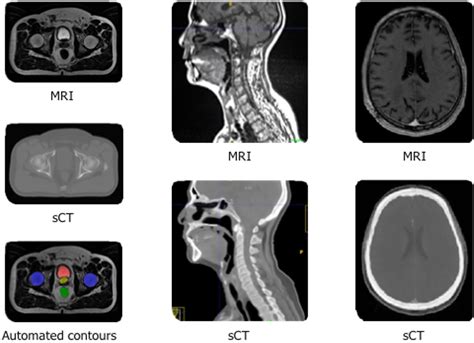 Enabling Radiation Oncology Treatment Planning with Advanced Imaging ...