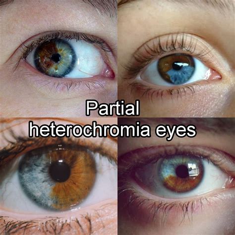 Partial heterochromia eyes 💙🤎💚💛 | Eye color chart, Pretty eyes color ...