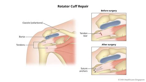 Image result for Rotator Cuff Repair Photo