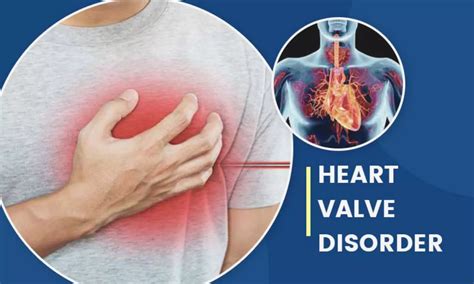 2025 ESC/EACTS Valvular Heart Disease Guidelines Stress Heart Team ...