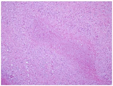 Cutaneous Manifestations of Rheumatoid Arthritis: Diagnosis and Treatment
