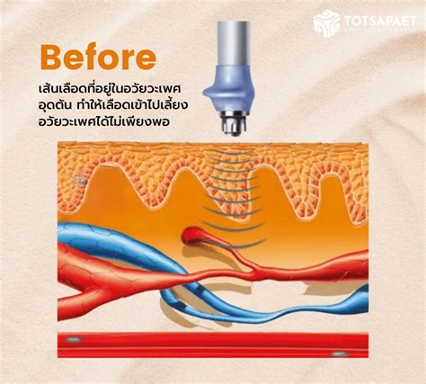 Image result for Ed Dysfunction Therapy