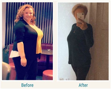Roux En Y Gastric Bypass Before After