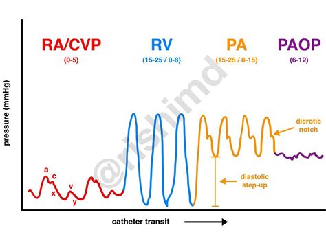 Image result for How Would You Draw SvO2 Form Pulmonary Artery Line