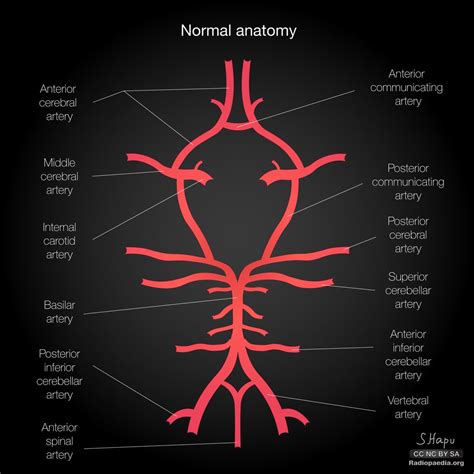 Common variants of the circle of Willis: diagrams | Radiology Case ...