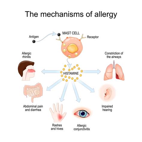 Meaning Of Allergist