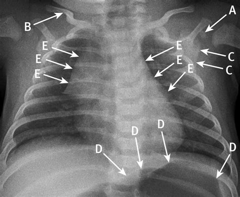 Anteroposterior chest radiograph in a 3 month old infant | The BMJ