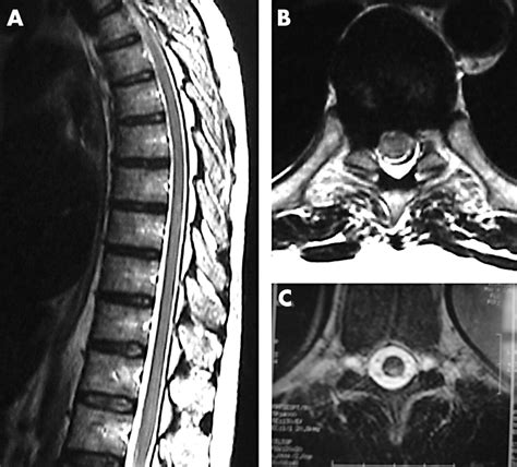 Anterior Cord Syndrome Mri