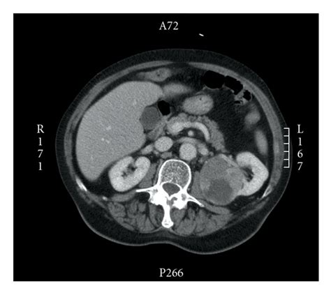 Image result for Hal Nephrectomy