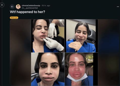 Uorfi Javed's shockingly swollen face after dissolving lip fillers: A ...