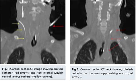 Vertebral Artery Injury with Dialysis Catheter