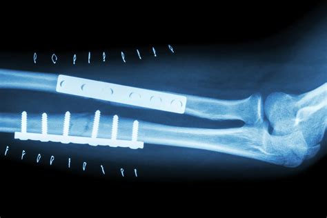 ORIF Surgery: When It's Needed and How It's Done