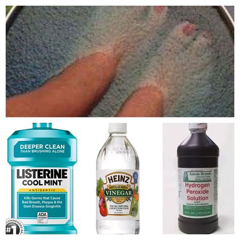 Does Soaking Your Feet In White Vinegar Kill Toenail Fungus at Keith Reavis blog