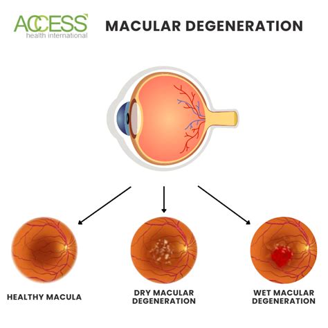 Dry Vs Wet Macular Degeneration