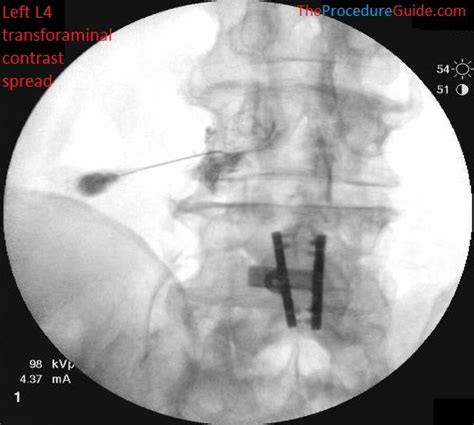 Image result for Fluoroscopy Injection