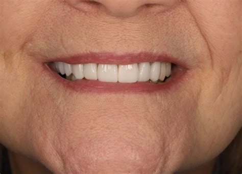 Gum Abscess Popped? Thinking of Popping It Yourself?