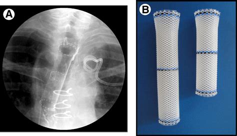 Stent In Esophagus