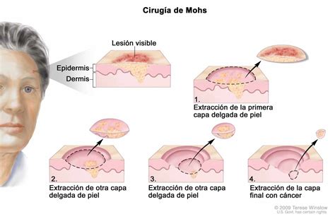 Cáncer de piel, síntomas, tratamiento y prevención